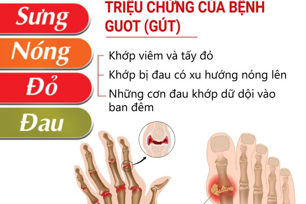 Bệnh Gout và cách điều trị 