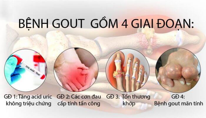 giai đoạn phát triển bệnh gout (gút)